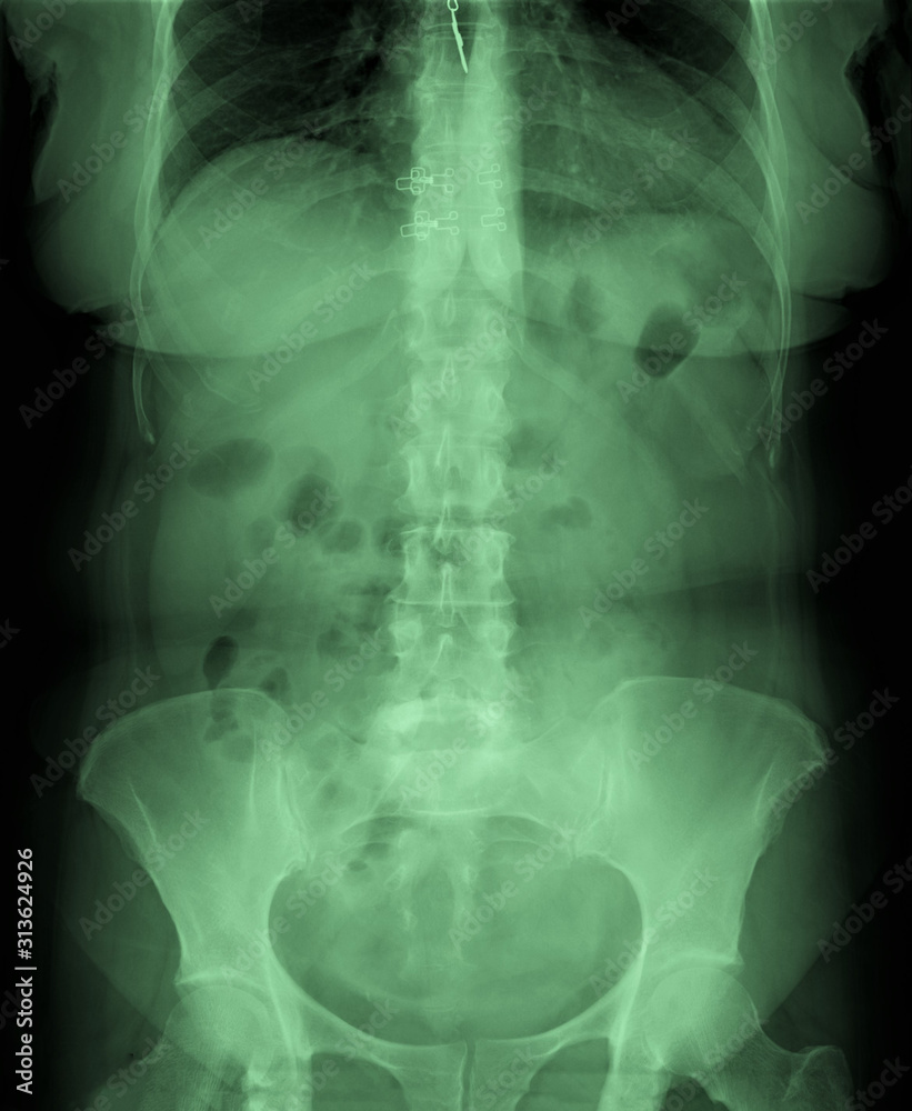 Fototapeta x-ray of the abdominal cavity and pelvis in direct projection, medical research,urography