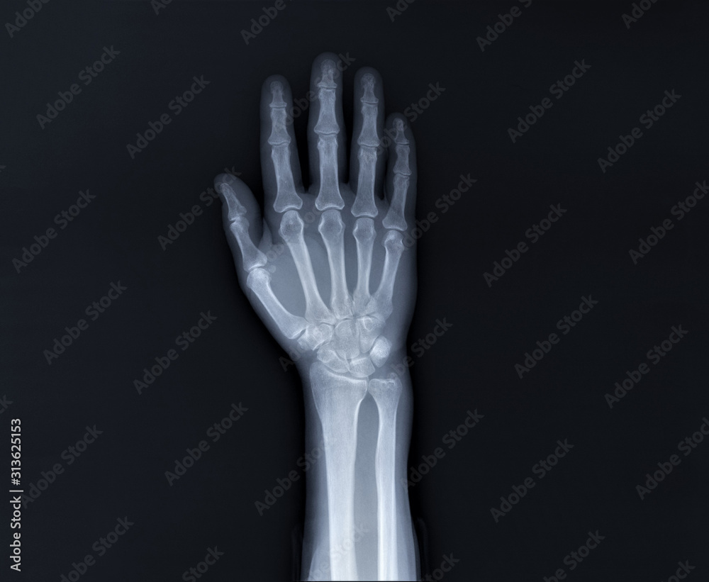 x-ray of hand bones, diagnosis of diseases x-ray of hand bones, diagnosis of diseases