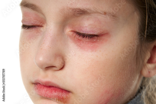 Allergic reaction, skin rash, close view portrait of a girl's face. Redness and inflammation of the skin in the eyes and lips. Immune system disease.