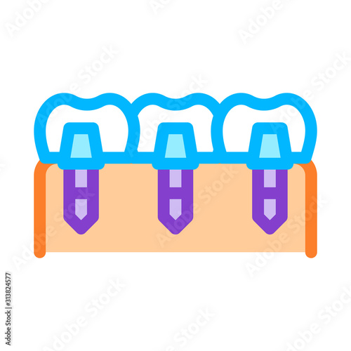 Dental Teeth Implants Biomaterial Vector Icon Thin Line. Biology And Science Flasks, Bioengineering, Dna And Medicine Biomaterial Concept Linear Pictogram. Contour Illustration
