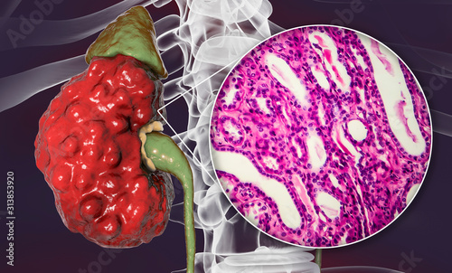 Chronic pyelonephritis, 3D illustration showing gross morphology with irregular scarred cortical surface and light micrograph showing interstitial fibrosis and inflammation photo