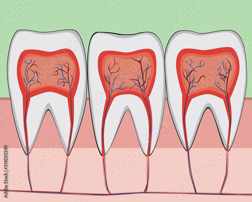 A molar structure with enamel and nerves on the gum and jaw,a  flat anatomical vector stock illustration with cutaway tooth or teeth for dentist or dental clinic