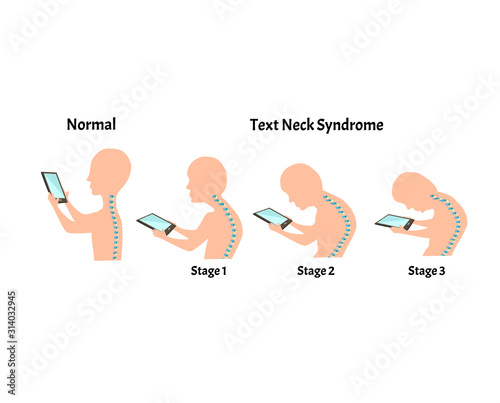 Improper posture symptoms. Stage Text Neck Syndrome. Spinal curvature, kyphosis, lordosis, scoliosis, arthrosis. Improper posture and stoop. Infographics. Vector illustration on isolated background.