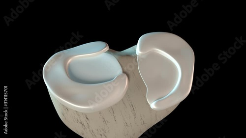 Meniscus Tear