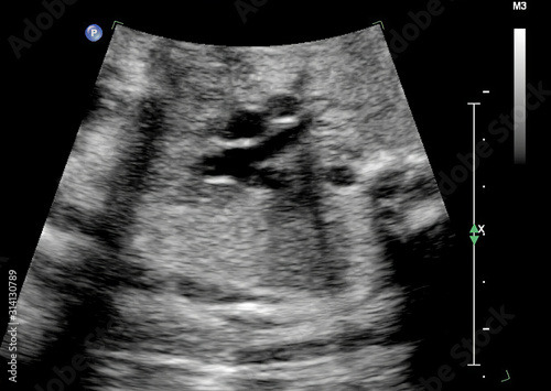 Ultrasound of fetus in third month pregnancy © jovannig