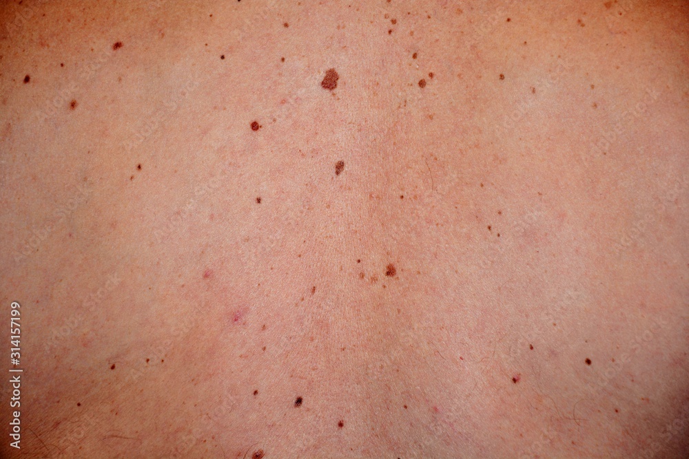 the back of a man with spots and moles