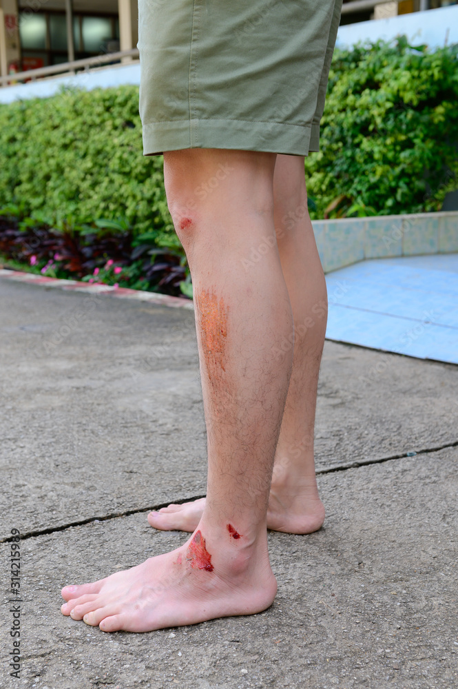 Human legs with fresh wound abrasion from the accident Human legs with fresh wound abrasion from the accident