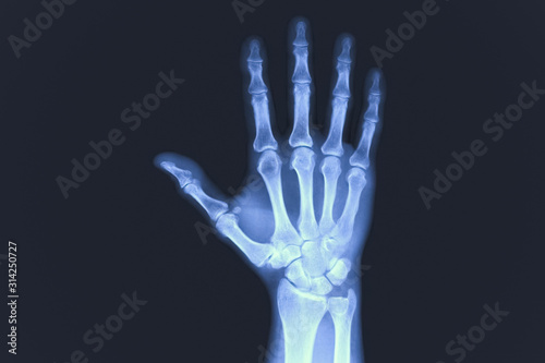 X-rayed human hand. X-ray of hand bones.