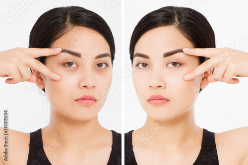 Asian close up woman happy face before after cosmetic procedures. Skin care wrinkled face, dark circles under eyes. Before-after anti-aging facelift treatment. Facial skincare, beauty contouring photo