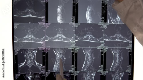 The doctor checks the results of MRI of the spine of the chest. The doctor examines the MRI image and shows the special places in the image with a pen. photo