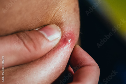 man squeezes a pimple