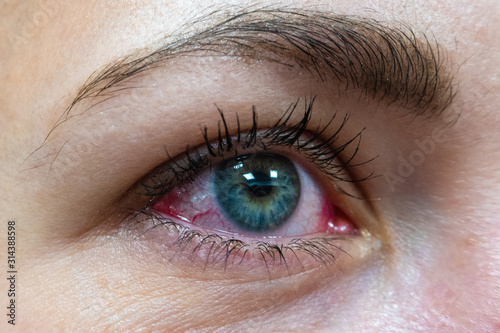 One female eye with red protein from allergic conjunctivitis