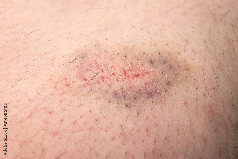 Bruise on male leg skin Bruise on male leg skin