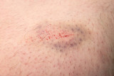 Bruise on male leg skin