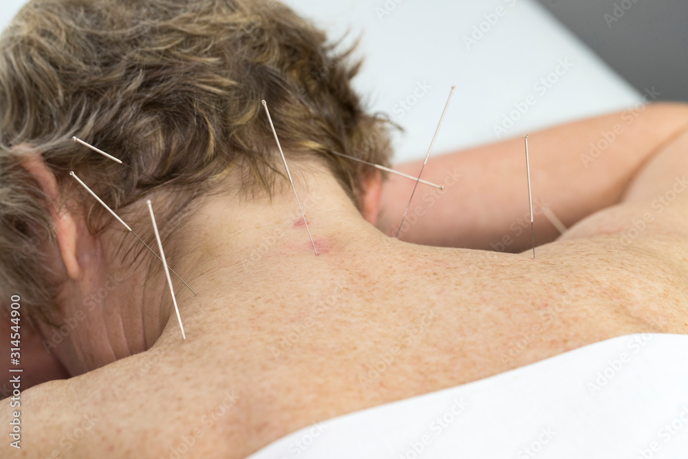 Elderly woman undergoing acupuncture procedure in a spa. Elderly woman undergoing acupuncture procedure in a spa.