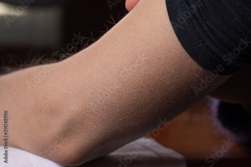 Canvastavla Female arm showing signs of keratosis pilaris in the form of reddish spots simil