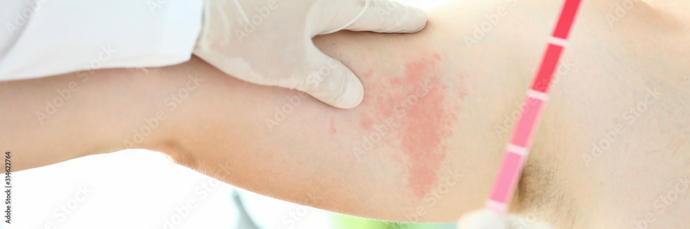 Focus on hardworking male hands in special medical gloves with spectrum inspecting painful sore on body of suffering patient. Professional dermatology clinic advertisement concept. Blurred background Focus on hardworking male hands in special medical gloves with spectrum inspecting painful sore on body of suffering patient. Professional dermatology clinic advertisement concept. Blurred background