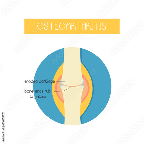 vector illustration of a bone with osteoarthritis