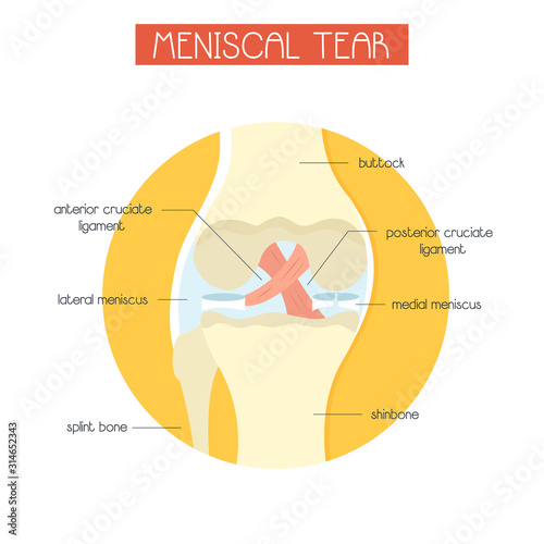 vector illustration of meniscal tear of knee joint