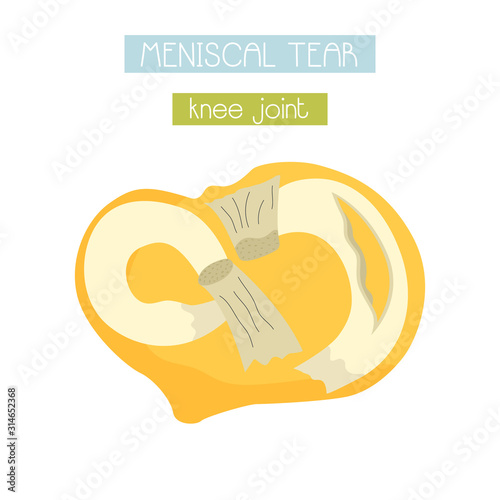 vector illustration of meniscal tear of knee joint photo