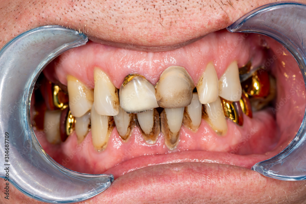 Obraz premium Plaque of the patient, stone. Dentistry treatment of dental plaque, professional oral hygiene. The concept of harm to smoking and cleaning teeth