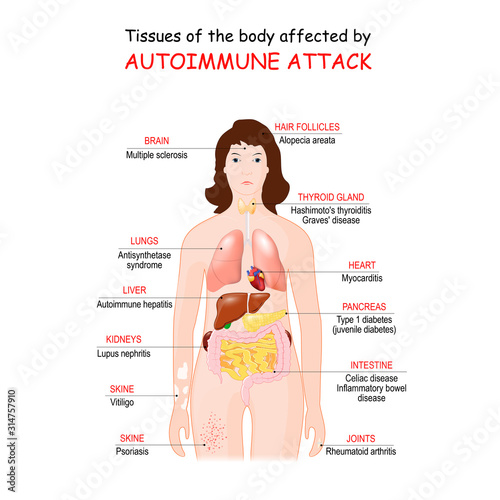 tissues of the body affected by autoimmune attack
