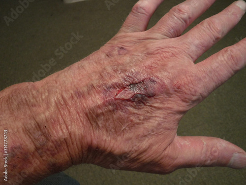 Torn Skin on Back of Hand