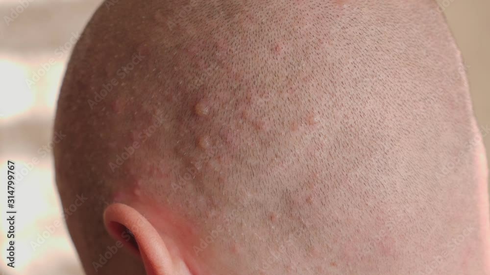 Close-up of a bald man's head with a rash on the skin from chickenpox. An adult male has varicella blister. Lots of red pimples on the skin. Slow motion. Close-up of a bald man's head with a rash on the skin from chickenpox. An adult male has varicella blister. Lots of red pimples on the skin. Slow motion.