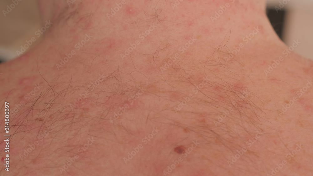 Close-up of the back and neck with rashes and blisters from chickenpox in an adult male. The hairy back and neck of an adult male with pimples from chickenpox. Close-up of the back and neck with rashes and blisters from chickenpox in an adult male. The hairy back and neck of an adult male with pimples from chickenpox.