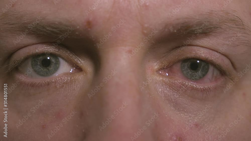 Close-up of one annoyed red blood eye of male affected by conjunctivitis or after flu, cold or allergy. Close-up of irritated red bloodshot eye after chicken pox at the man. Close-up of one annoyed red blood eye of male affected by conjunctivitis or after flu, cold or allergy. Close-up of irritated red bloodshot eye after chicken pox at the man.