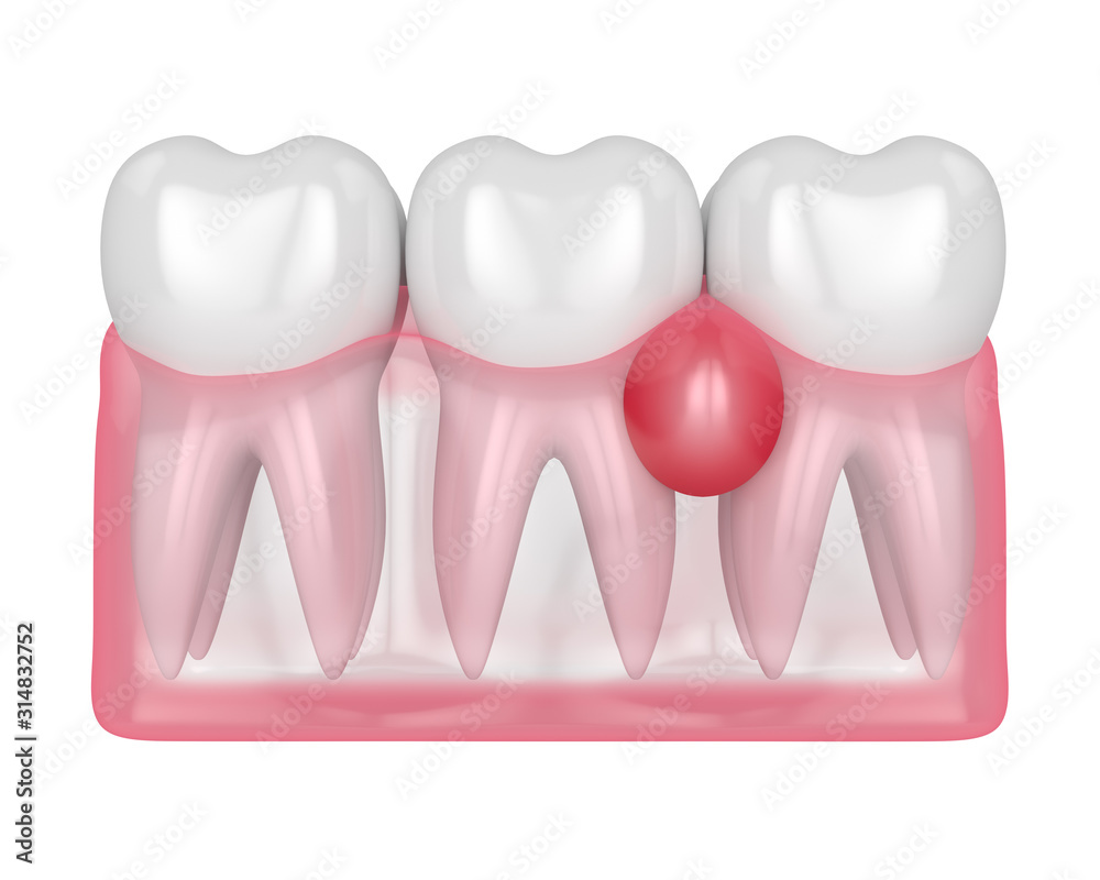 3d render of teeth in gums with cyst 3d render of teeth in gums with cyst