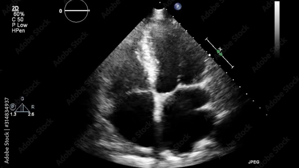Transesophageal ultrasound video in gray-scale mode.