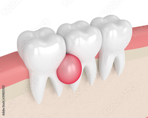 3d render of teeth in gums with cyst