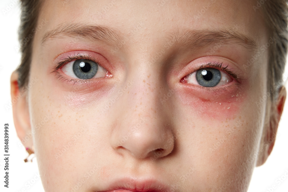 Allergic reaction, skin rash, close view portrait of a girl's face. Redness and inflammation of the skin in the eyes and lips. Immune system disease. Allergic reaction, skin rash, close view portrait of a girl's face. Redness and inflammation of the skin in the eyes and lips. Immune system disease.