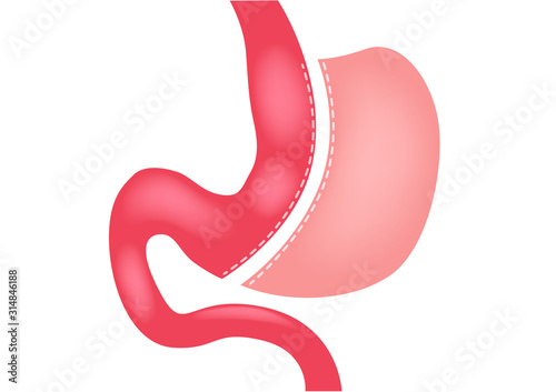 Schilderij op canvas laparoscopic gastrectomy Gastric Sleeve / weight loss surgery vector