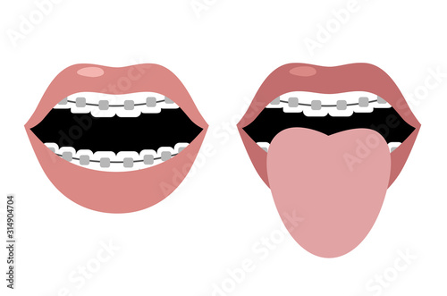 Open mouth with braces and tongue sticking out. Vector image. Flat design