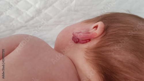 Infantile hemangioma 