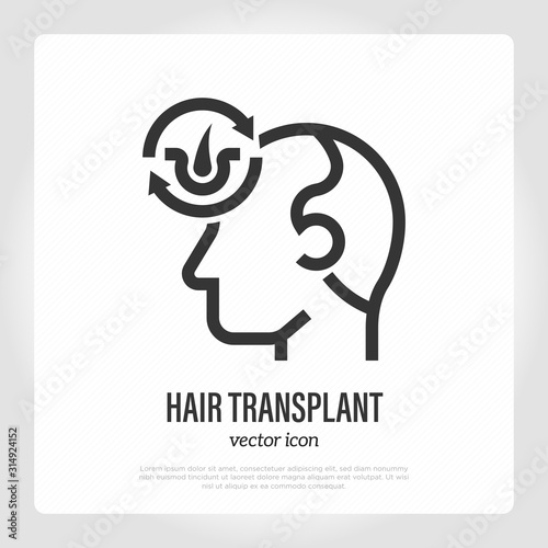 Hair transplantation thin line icon. Hair folicles in arrows. Medical procedure of extraction follicles. Vector illustration.