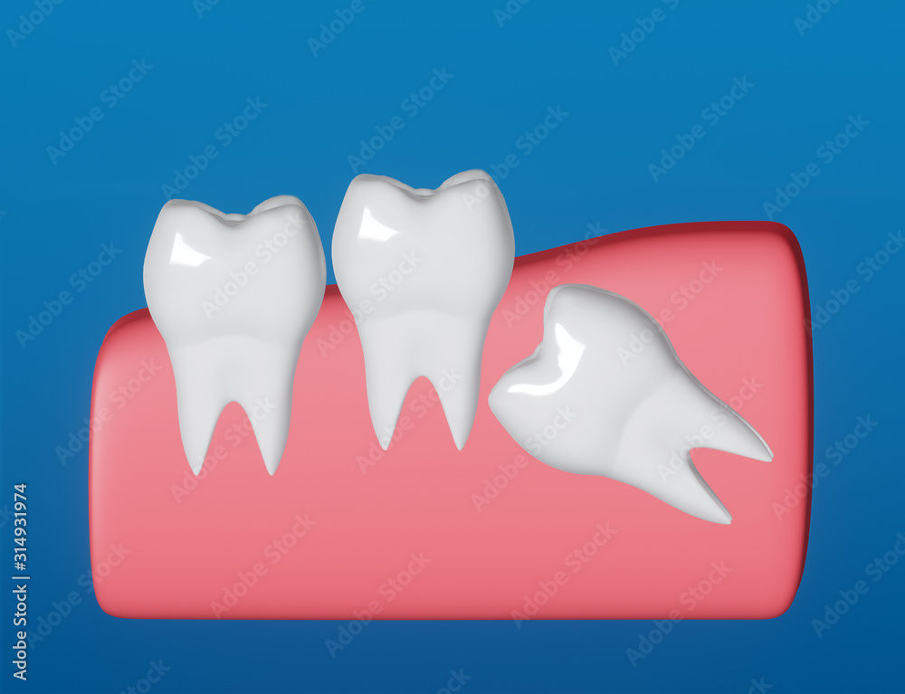 Wisdom tooth grows wrong, horizontal position of the wisdom tooth, Impacted wisdom tooth. 3d illustration.