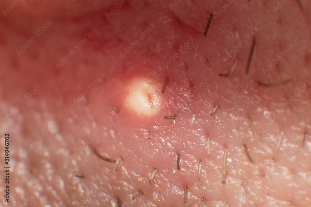 Fototapeta premium Acne pus, Close up photo of acne prone skin