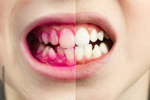 Plaque disclosing tablets in work. Before and after - effect. close up photo of young boy tooth. Dental plaque pill concept photo