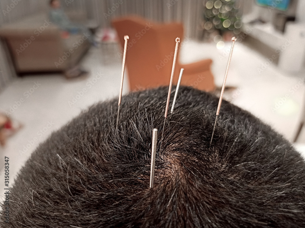 Chinese Acupuncture Needles