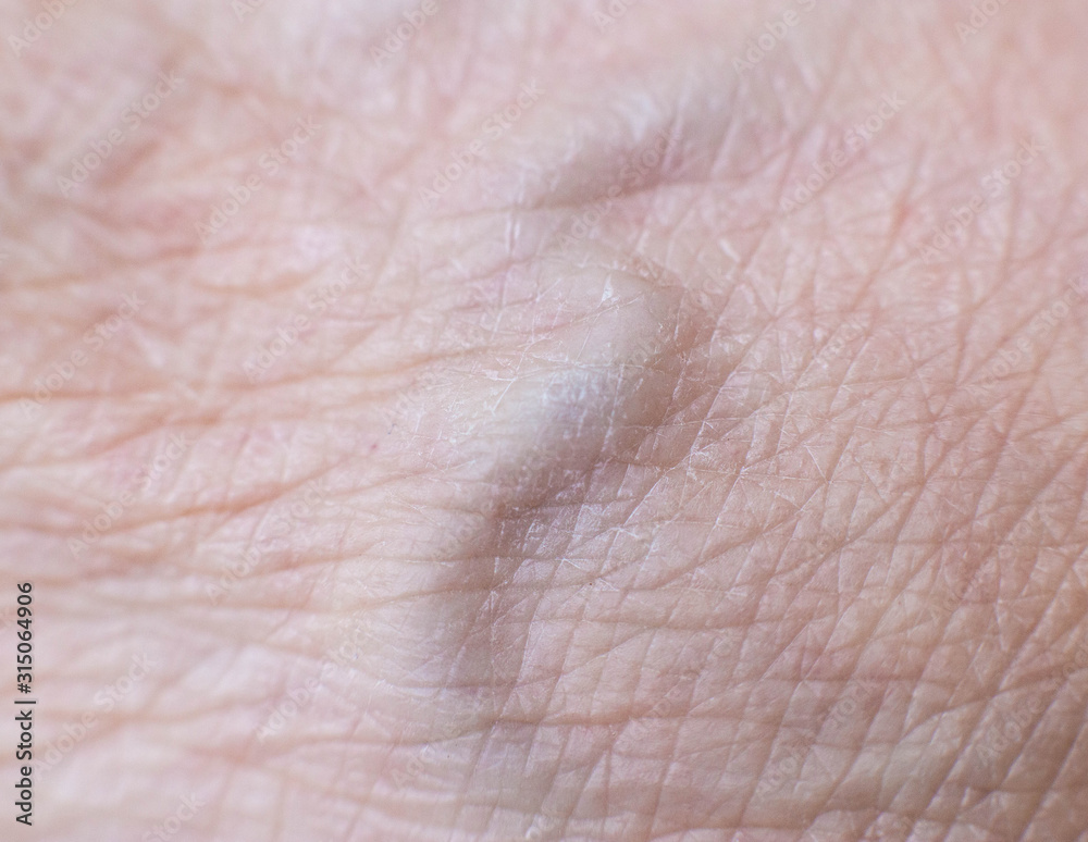 convex vein on the skin of a person, background. Varicose veins concept, macro convex vein on the skin of a person, background. Varicose veins concept, macro