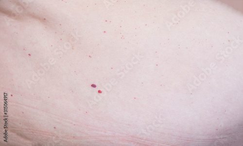 Red moles of nevi on the abdomen in humans, hemangioma photo