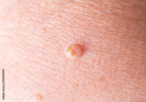 large wart on the skin of a person, background, macro, dermatology