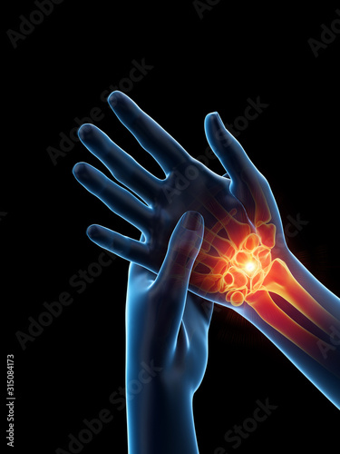 3d rendered medically accurate illustration of a woman having a painful hand