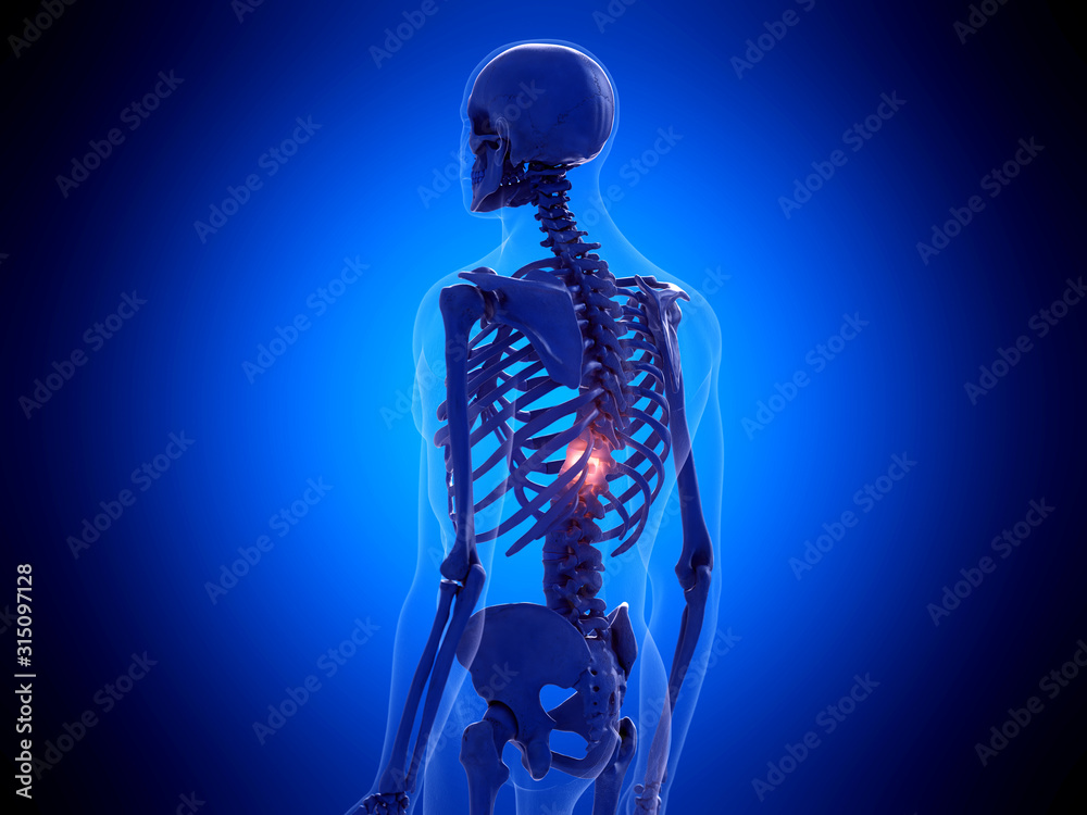 3d rendered medically accurate illustration of a painful spine
