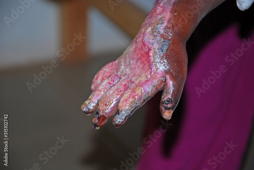 The serious burns to a hand of a child African-Tanzania-Africa