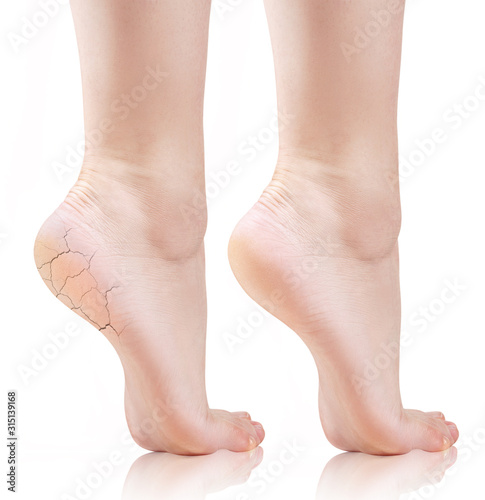 Female feet with cracks and dry skin on heels before and after treatment.