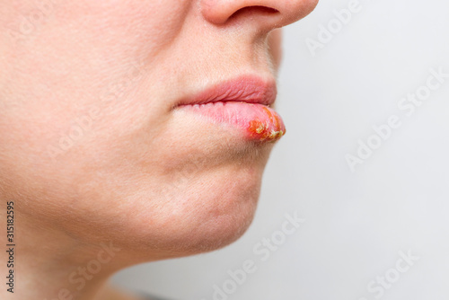 Part of a young woman's face with a virus herpes on lips. Closeup of a common cold sore virus herpes